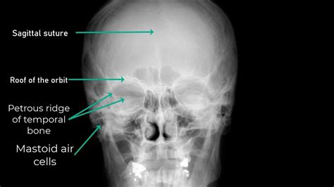 ap skull watch|skull ap x ray anatomy.